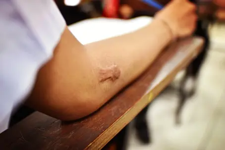healed burn